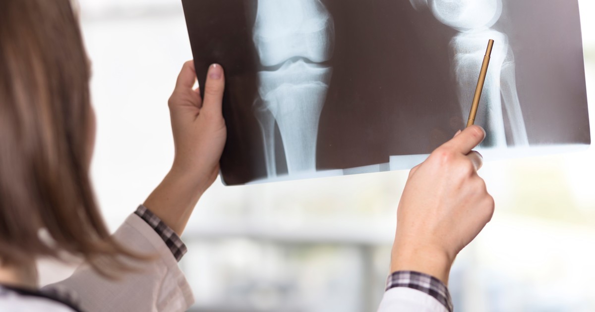 Osteogénesis imperfecta: qué causa huesos frágiles en los niños